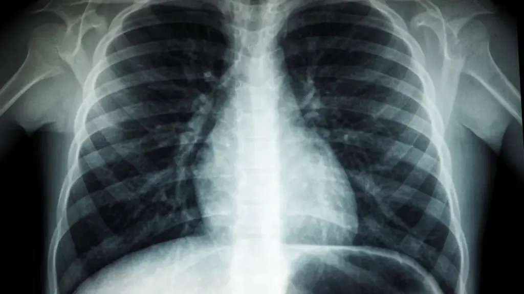 Une radiographie thoracique montrant les poumons pour un dépistage médical de la tuberculose.